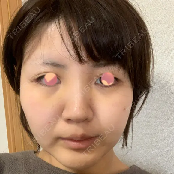 バッカルファット除去 湘南美容クリニック 新潟院 DAY 8 メイン用