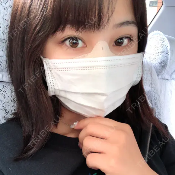 二重埋没 / 隆鼻術 共立美容外科 名古屋院 DAY 0 メイン用