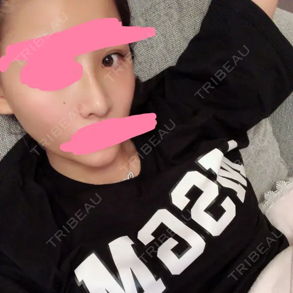 二重埋没 / 隆鼻術 共立美容外科 名古屋院 DAY 2 メイン用