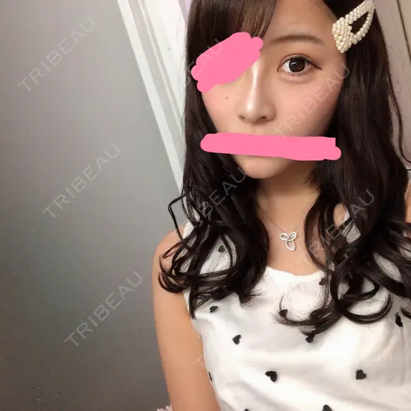 二重埋没 / 隆鼻術 共立美容外科 名古屋院 AFTER メイン用