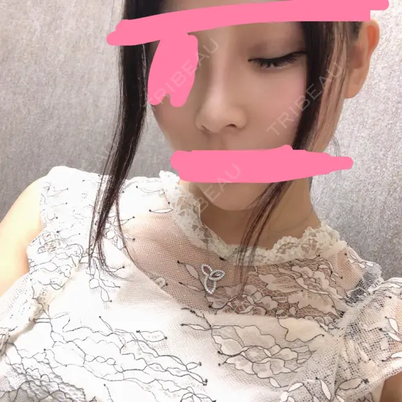 二重埋没 / 隆鼻術 共立美容外科 名古屋院 DAY 7 メイン用