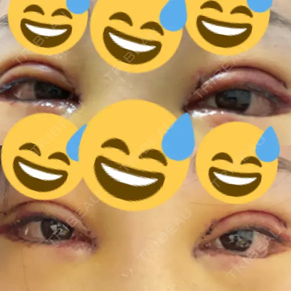 二重切開 / 目頭切開 / 鼻尖形成（切開） / 鼻中隔延長（切開） / 小鼻縮小（切開） / タレ目形成・グラマラスライン（切開） / 鼻尖縮小 / 鼻翼基部形成（貴族手術） グローバルビューティークリニック 大阪院 DAY 4 メイン用