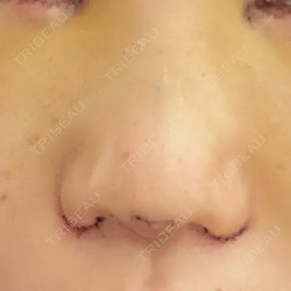 二重切開 / 目頭切開 / 鼻尖形成（切開） / 鼻中隔延長（切開） / 小鼻縮小（切開） / タレ目形成・グラマラスライン（切開） / 鼻尖縮小 / 鼻翼基部形成（貴族手術） グローバルビューティークリニック 大阪院 DAY 4 メイン用