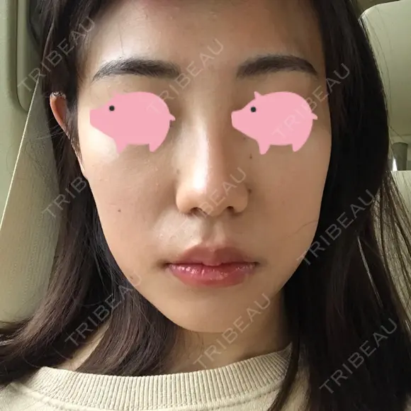 脂肪溶解注射（顔） / 美容点滴・美容注射（美肌） / ボトックス（肩） / ハイフ（顔） リエンジャン整形外科 江南店 DAY 15 メイン用