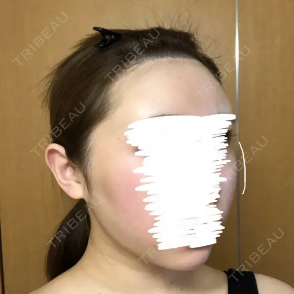 糸リフト / 骨削り（頬） / 脂肪吸引（顔） RG整形外科（旧リオン整形外科） DAY 29 メイン用