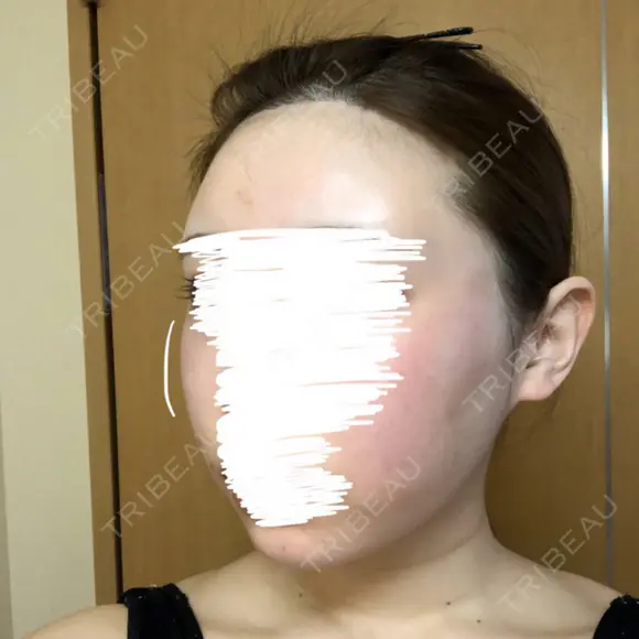 糸リフト / 骨削り（頬） / 脂肪吸引（顔） RG整形外科（旧リオン整形外科） DAY 29 メイン用