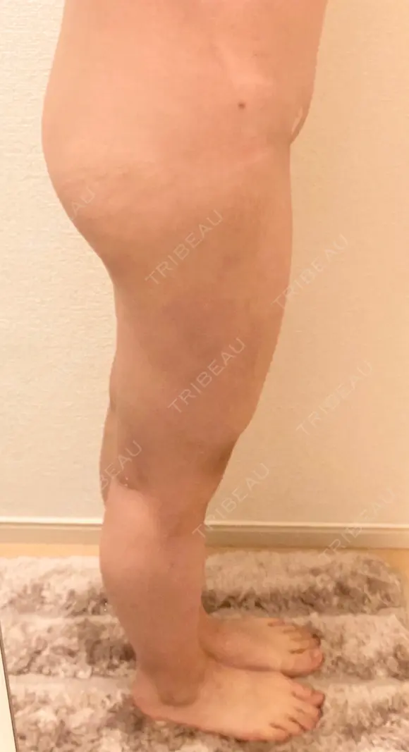 脂肪吸引（脚） / 脂肪吸引（お尻） ドクターフィット（Dr.fit）クリニック DAY 72 メイン用