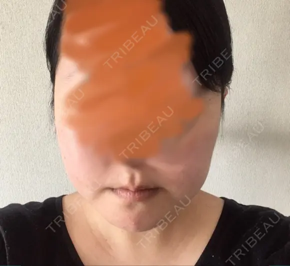 骨切り（あご） ボンディ美容整形外科（旧リオン整形外科） DAY 31 メイン用