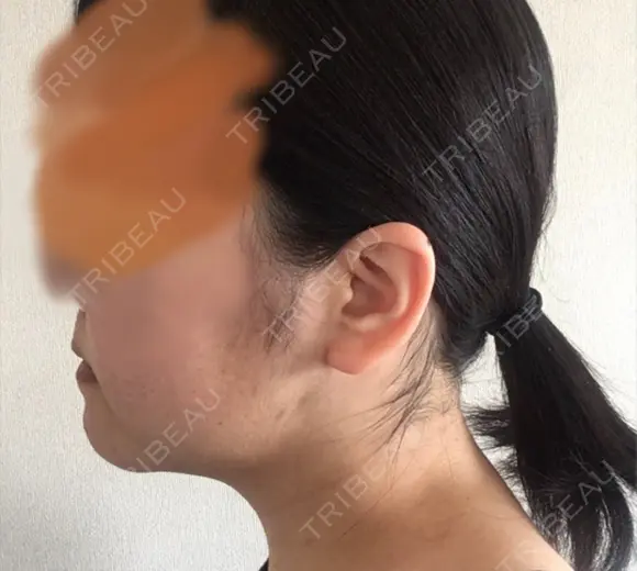 骨切り（あご） ボンディ美容整形外科（旧リオン整形外科） DAY 31 メイン用