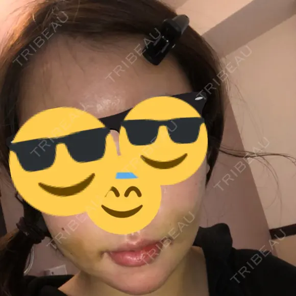 骨切り（あご） / 骨削り（エラ） / 脂肪注入（額） ボンディ美容整形外科（旧リオン整形外科） DAY 5 メイン用