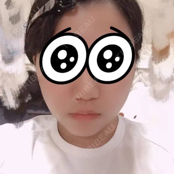 脂肪吸引（顔） 湘南美容クリニック 渋谷院 DAY 10 メイン用