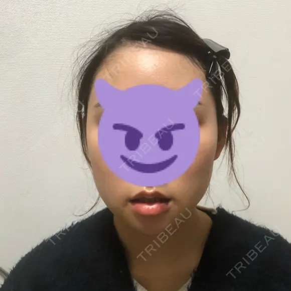 骨切り（あご） / 骨削り（エラ） ボンディ美容整形外科（旧リオン整形外科） DAY 7 メイン用