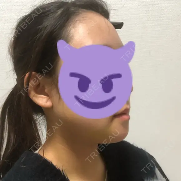 骨切り（あご） / 骨削り（エラ） ボンディ美容整形外科（旧リオン整形外科） DAY 7 メイン用