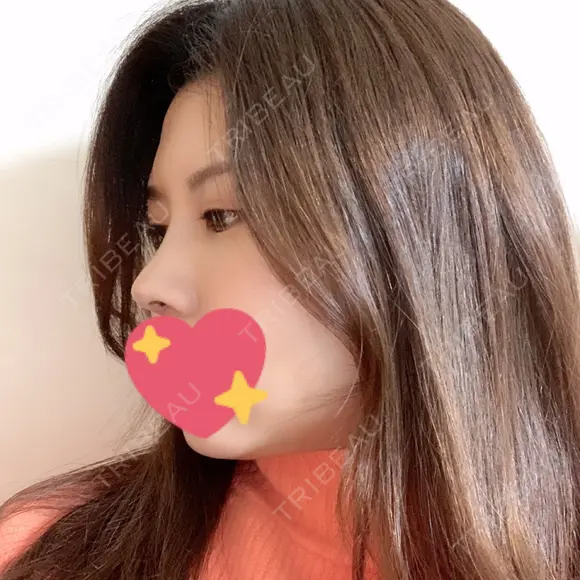 鼻中隔延長（切開） / 軟骨移植 / 眉間プロテーゼ FROM B整形外科 (旧バウム整形外科) AFTER メイン用