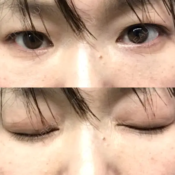 下まぶたたるみ取り セオリークリニック AFTER メイン用