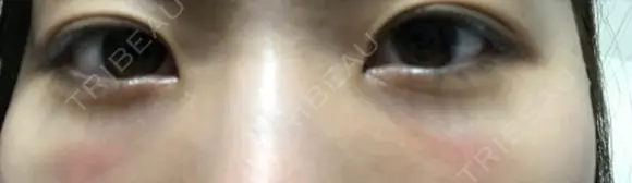 下まぶたたるみ取り セオリークリニック DAY 0 メイン用