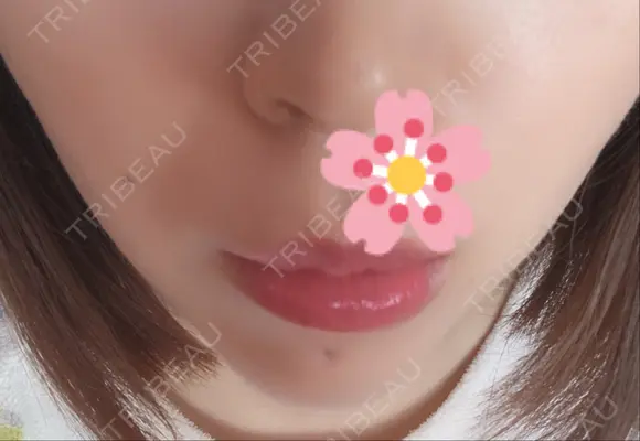 ボトックス（あご） / ヒアルロン酸注入（あご） / その他（輪郭） 品川美容外科 仙台院 AFTER メイン用