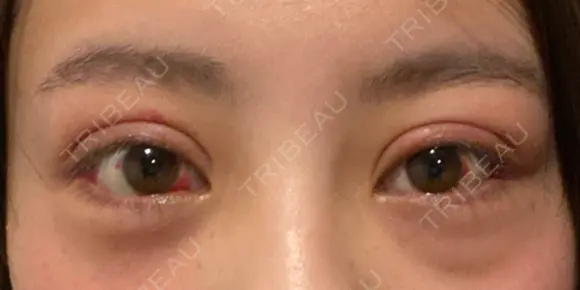 二重切開 / 眼瞼下垂（切開） / 目尻切開 / 上まぶたの脂肪取り / タレ目形成・グラマラスライン（切開） id（アイディ）美容外科 DAY 14 メイン用