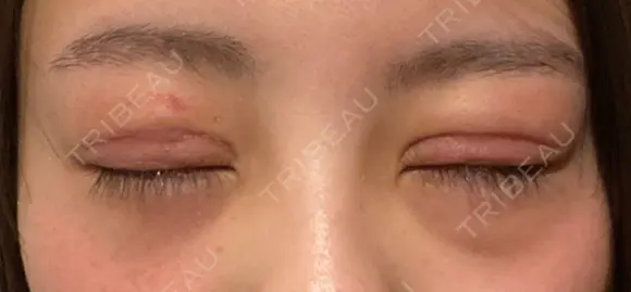 二重切開 / 眼瞼下垂（切開） / 目尻切開 / 上まぶたの脂肪取り / タレ目形成・グラマラスライン（切開） id（アイディ）美容外科 DAY 14 メイン用