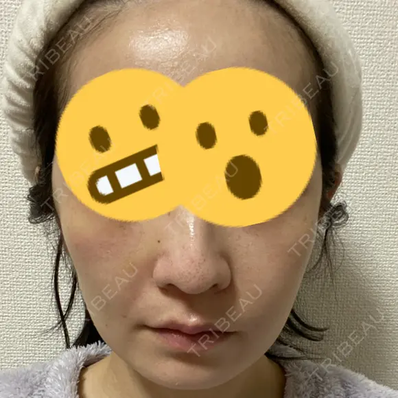 骨削り（頬） RG整形外科（旧リオン整形外科） DAY 11 メイン用