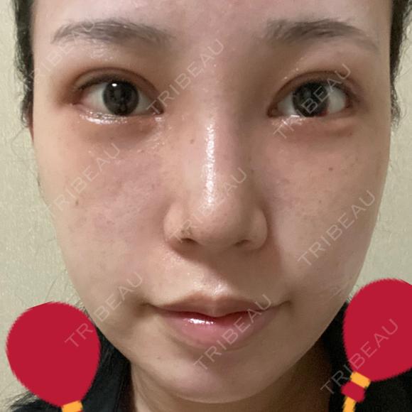目頭切開 / 鼻尖形成（切開） / 額を丸く / 目尻切開 / 上まぶたの脂肪取り / 軟骨移植 / 脂肪注入（輪郭） TN整形外科 DAY 11 メイン用