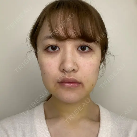 骨切り（あご） / 骨削り（エラ） ボンディ美容整形外科（旧リオン整形外科） DAY 7 メイン用