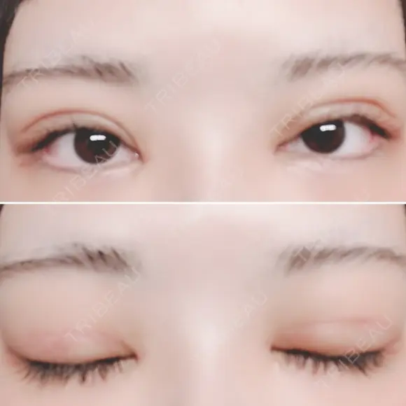 二重切開 / 目頭切開 / 上まぶたたるみ取り 湘南美容クリニック 金沢院 DAY 8 メイン用