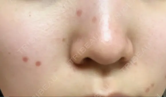 ほくろ・いぼ切除（肌） 赤坂メディカルMクリニック AFTER メイン用