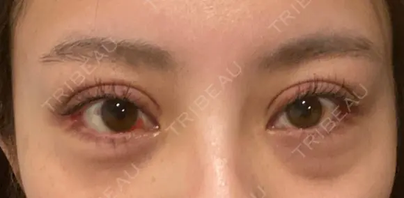 二重切開 / 眼瞼下垂（切開） / 目尻切開 / 上まぶたの脂肪取り / タレ目形成・グラマラスライン（切開） id（アイディ）美容外科 DAY 17 メイン用