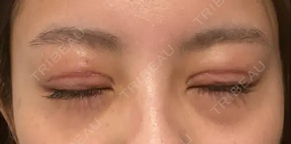 二重切開 / 眼瞼下垂（切開） / 目尻切開 / 上まぶたの脂肪取り / タレ目形成・グラマラスライン（切開） id（アイディ）美容外科 DAY 17 メイン用