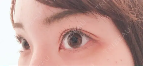 二重埋没 / 上まぶたの脂肪取り TCB東京中央美容外科 江坂院 DAY 40 メイン用