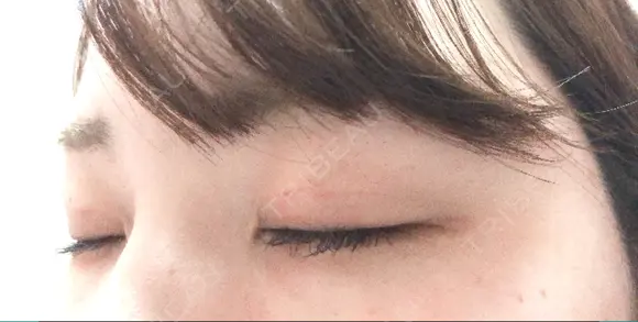 二重埋没 / 上まぶたの脂肪取り TCB東京中央美容外科 江坂院 DAY 40 メイン用