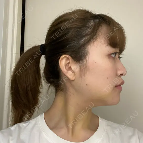 骨切り（あご） / 骨削り（エラ） ボンディ美容整形外科（旧リオン整形外科） DAY 8 メイン用