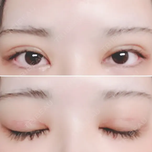 二重切開 / 目頭切開 / 上まぶたたるみ取り 湘南美容クリニック 金沢院 DAY 9 メイン用