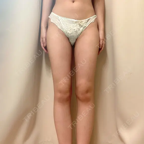 脂肪吸引（脚） / 豊胸（脂肪注入） / 脂肪溶解注射 ラインカルチャークリニック AFTER メイン用