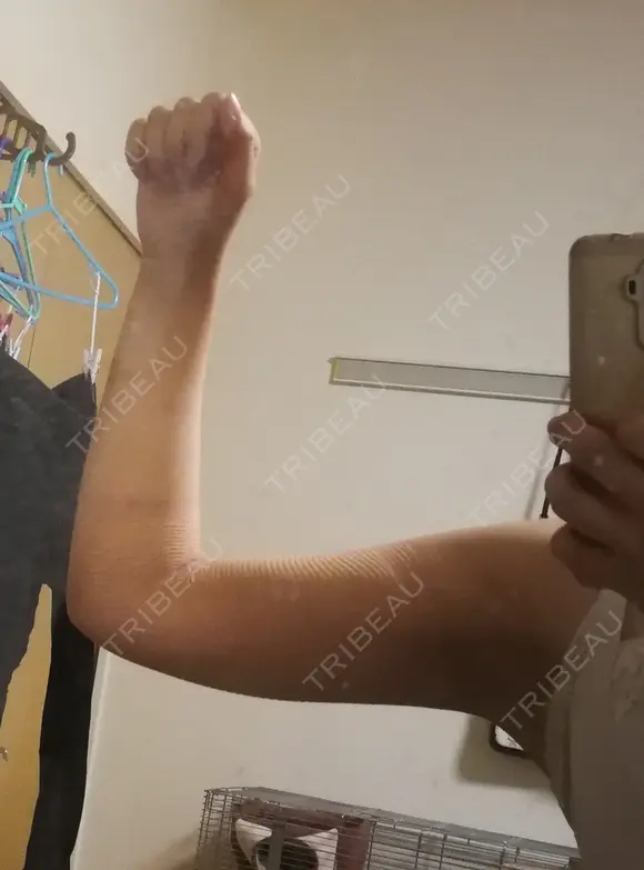 脂肪吸引（二の腕） プチパーティー医院 AFTER メイン用