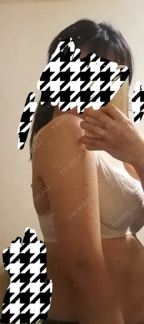 脂肪吸引（二の腕） プチパーティー医院 DAY 37 メイン用