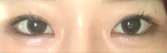 目頭切開 / 下まぶたの脂肪取り / タレ目形成・グラマラスライン（切開） ララ整形外科 DAY 32 メイン用
