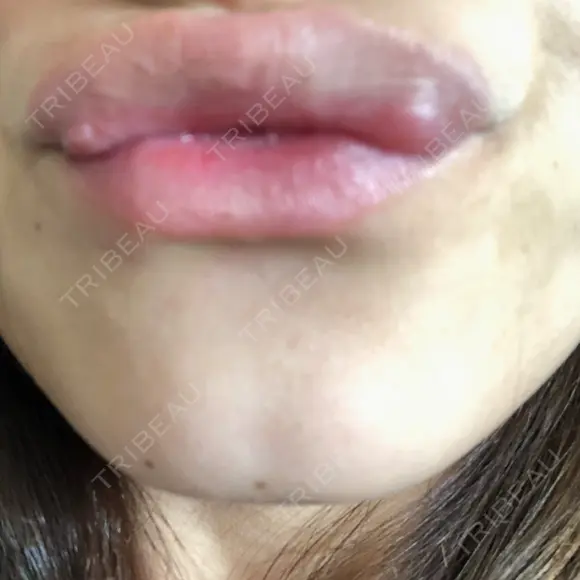 ボトックス（あご） TCB東京中央美容外科 京都駅前院 AFTER メイン用