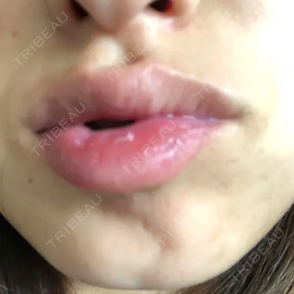 ボトックス（あご） TCB東京中央美容外科 京都駅前院 DAY 18 メイン用