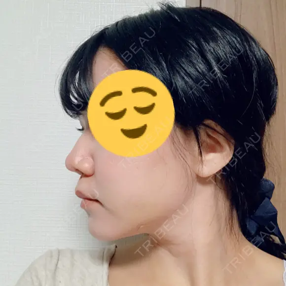 糸リフト / 脂肪吸引（顔） / その他（肌） ビューティーライン美容外科 DAY 13 メイン用