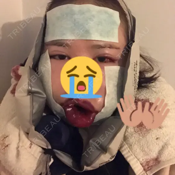 骨切り（あご） / 骨削り（エラ） ボンディ美容整形外科（旧リオン整形外科） DAY 1 メイン用