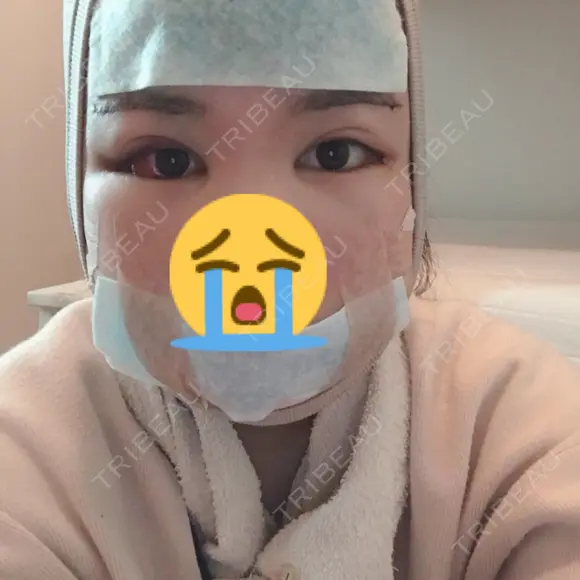 骨切り（あご） / 骨削り（エラ） ボンディ美容整形外科（旧リオン整形外科） DAY 2 メイン用