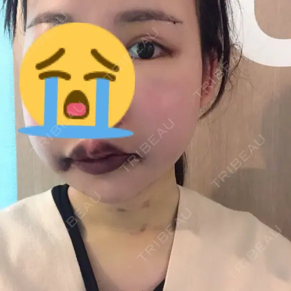 骨切り（あご） / 骨削り（エラ） ボンディ美容整形外科（旧リオン整形外科） AFTER メイン用