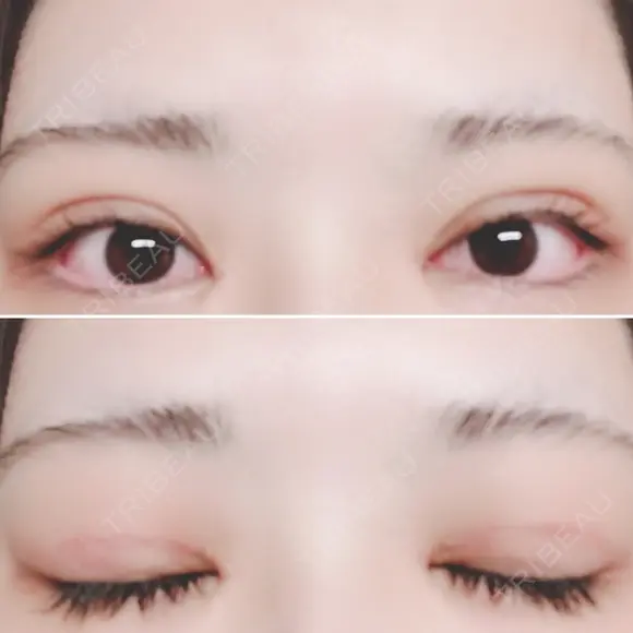 二重切開 / 目頭切開 / 上まぶたたるみ取り 湘南美容クリニック 金沢院 DAY 11 メイン用