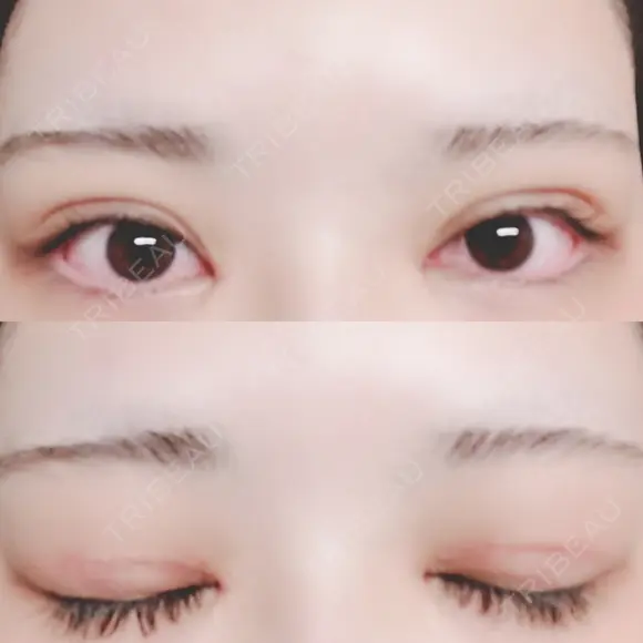 二重切開 / 目頭切開 / 上まぶたたるみ取り 湘南美容クリニック 金沢院 DAY 13 メイン用