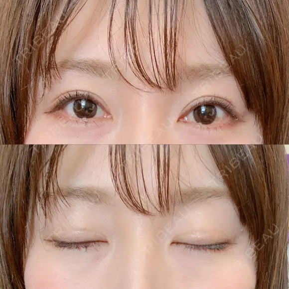 二重切開 / 眼瞼下垂（切開） / 上まぶたたるみ取り 湘南美容クリニック 新宿南口院 AFTER メイン用