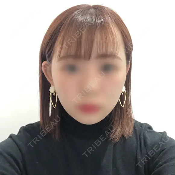 バッカルファット除去 / ボトックス（エラ・小顔） 湘南美容クリニック 秋葉原院 DAY 48 メイン用