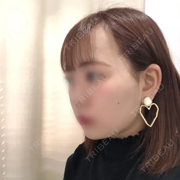 バッカルファット除去 / ボトックス（エラ・小顔） 湘南美容クリニック 秋葉原院 DAY 48 メイン用