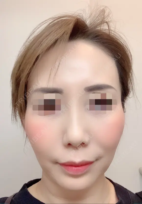 その他（目元） / クマ治療 / 額を丸く / その他（輪郭） / 下まぶたの脂肪取り / 脂肪注入（肌） / こめかみ形成 / 脂肪注入（額） / ヒアルロン酸注入（涙袋） / 脂肪注入（輪郭） / PRP皮膚再生療法 ジュエリー美容外科 AFTER メイン用